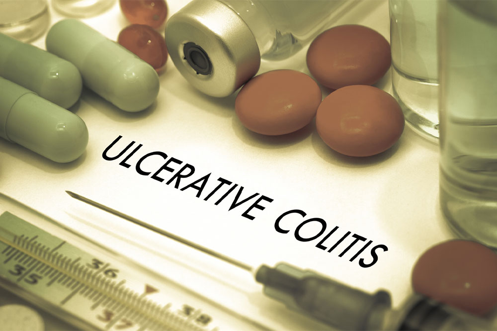 Things to know about ulcerative colitis