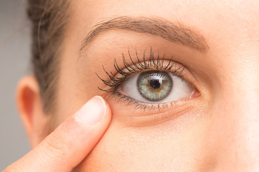 Bags under eyes &#8211; Common causes and management