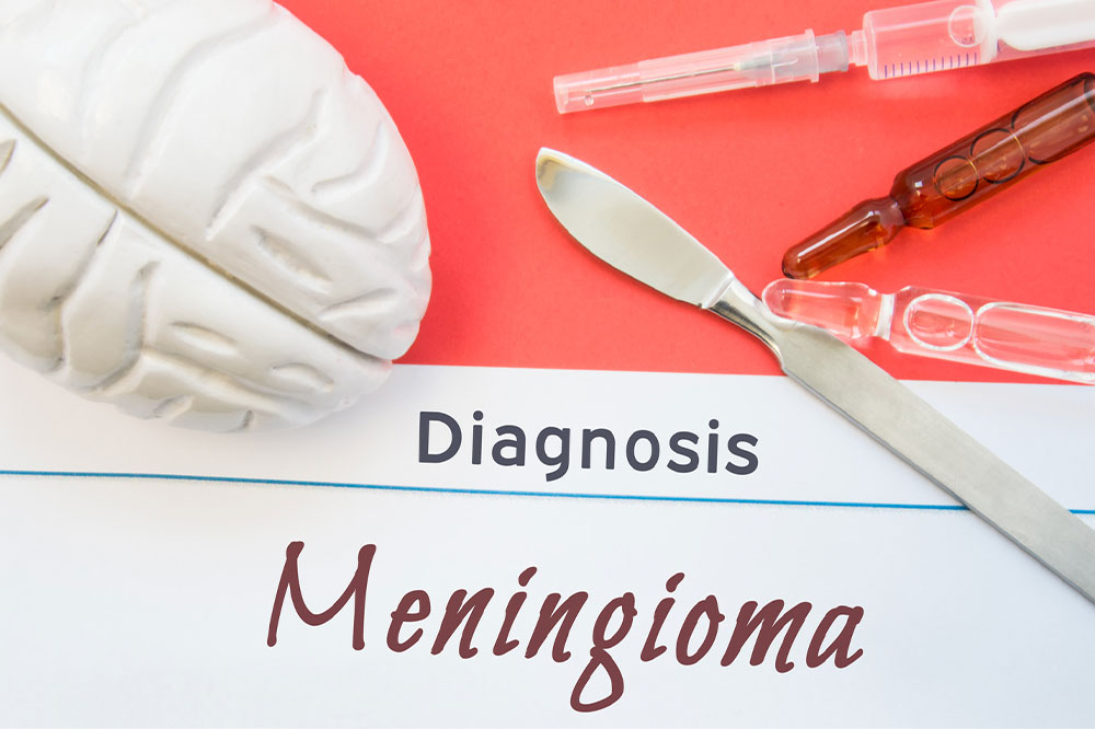 Meningioma &#8211; Causes, symptoms, and management