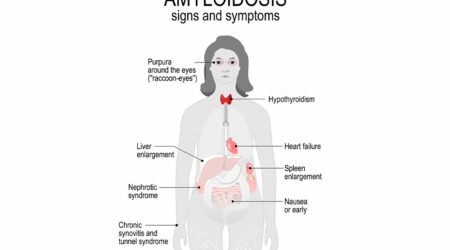 Causes, types, symptoms, and risk factors of amyloid disease