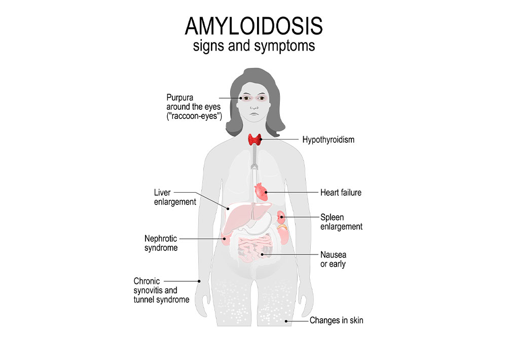 Causes, types, symptoms, and risk factors of amyloid disease