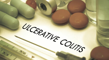 Things to know about ulcerative colitis