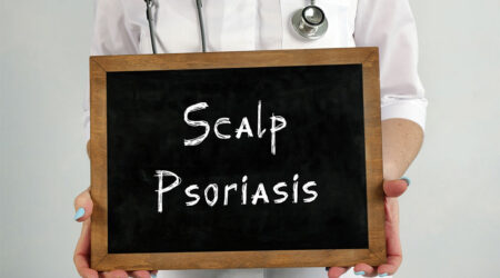 All one needs to know about scalp psoriasis