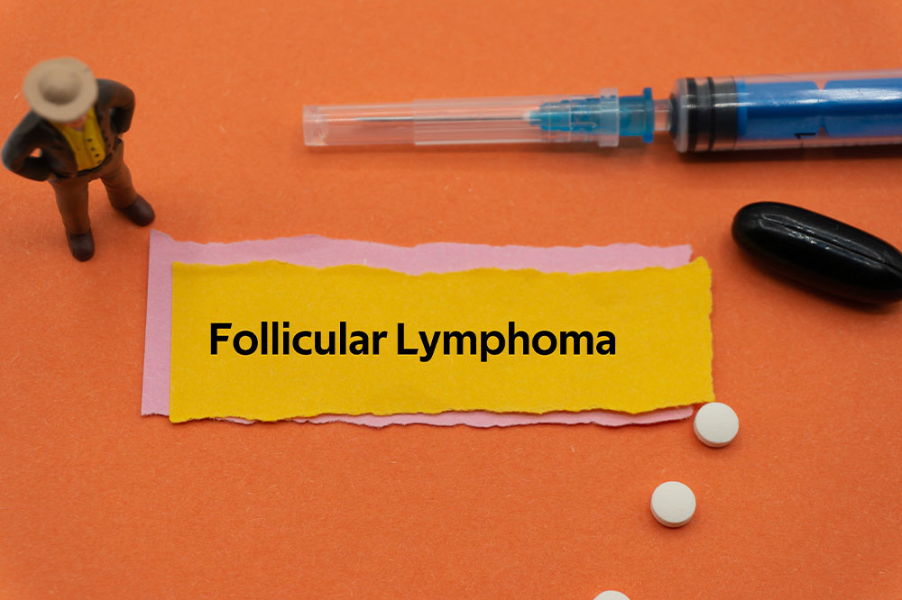 Follicular lymphoma &#8211; Causes, symptoms, diagnosis, and more