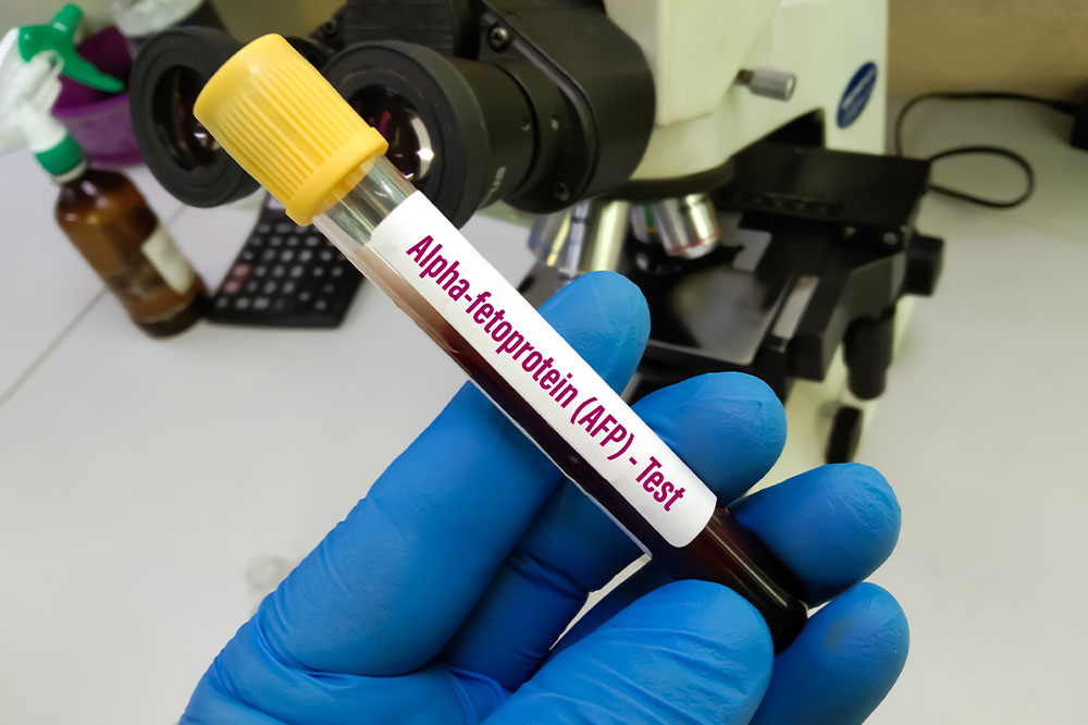 The alpha-fetoprotein test and its advantages