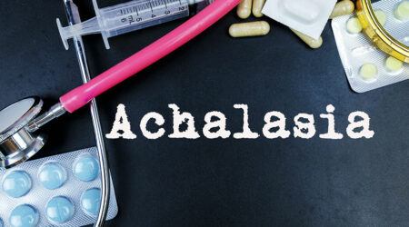 Achalasia &#8211; Symptoms, causes, and management