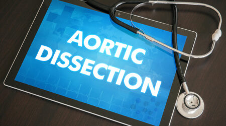 Aortic dissection &#8211; Causes, symptoms, and management