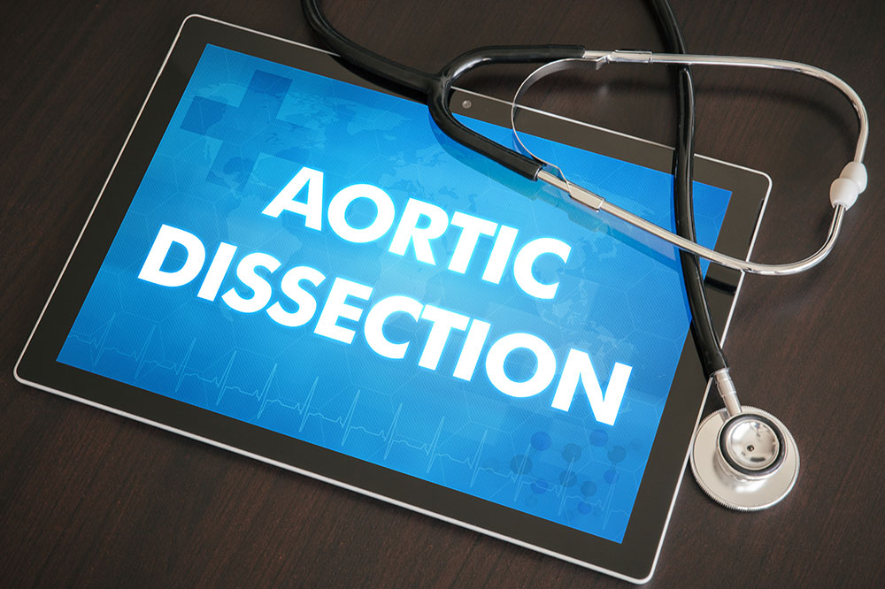 Aortic dissection &#8211; Causes, symptoms, and management