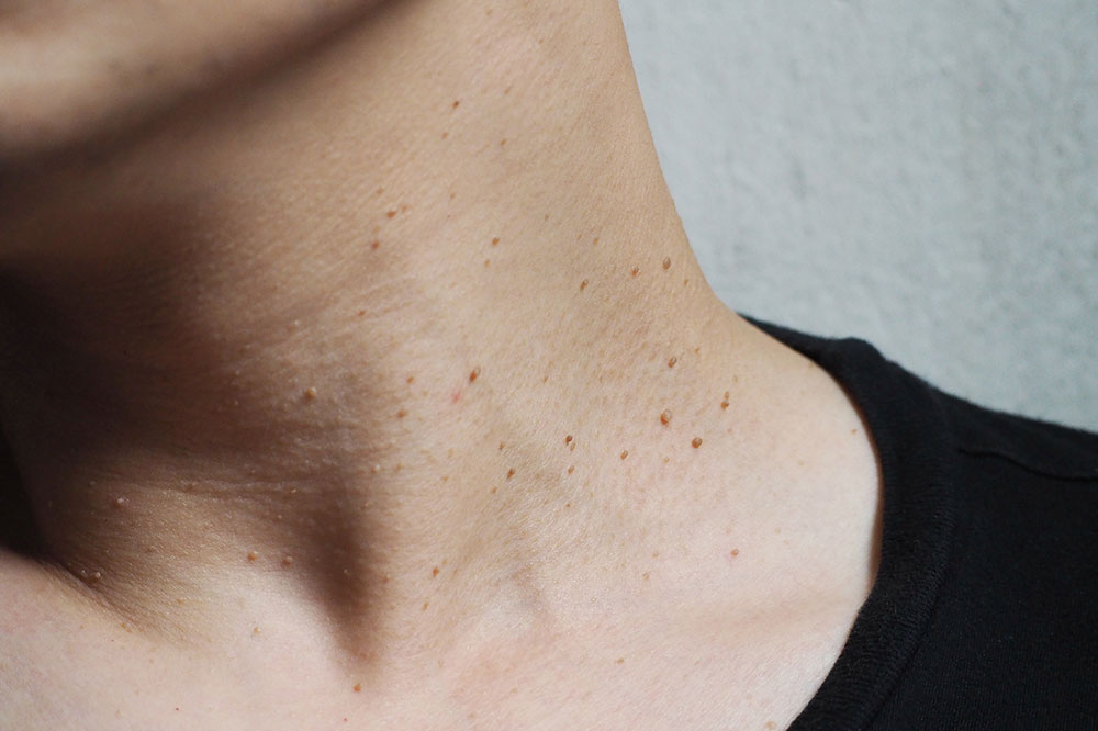 Causes, symptoms, and management of acrochordons (skin tag)