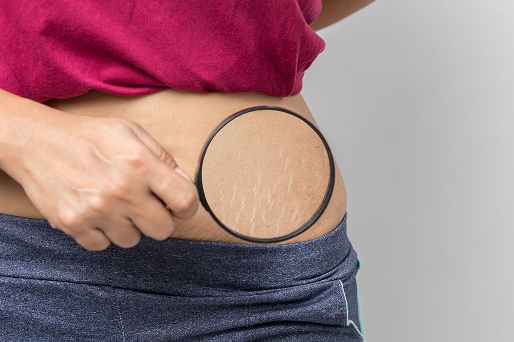 Dealing with stretch marks &#8211; Causes, remedies, and prevention