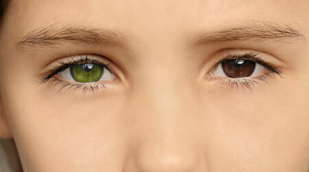 Heterochromia iridis &#8211; Causes, signs, and management