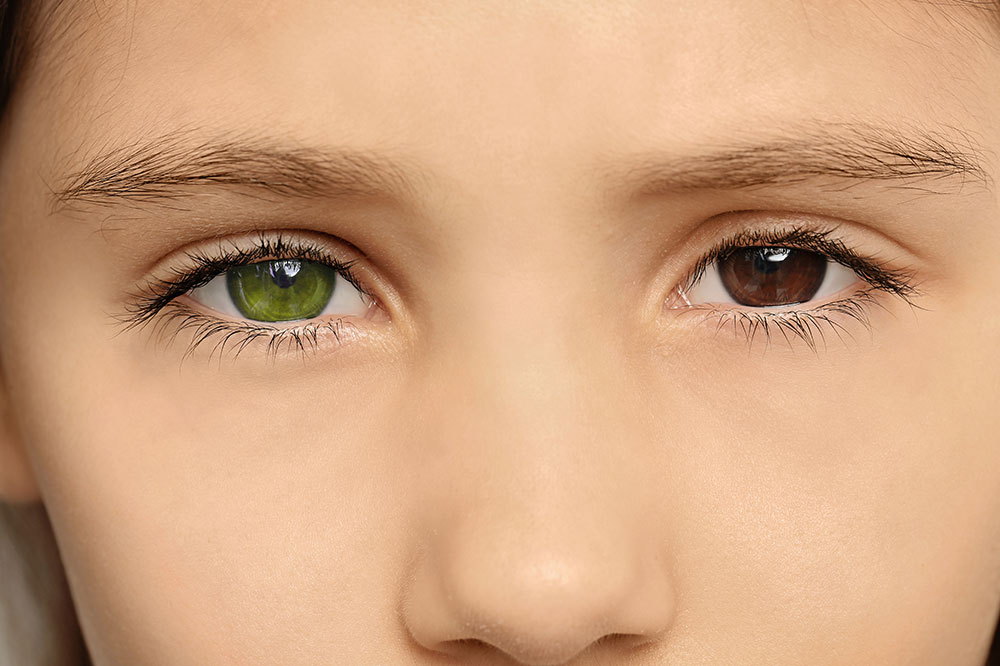 Heterochromia iridis &#8211; Causes, signs, and management