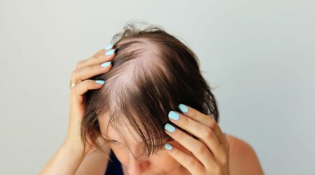 Important elements of alopecia areata