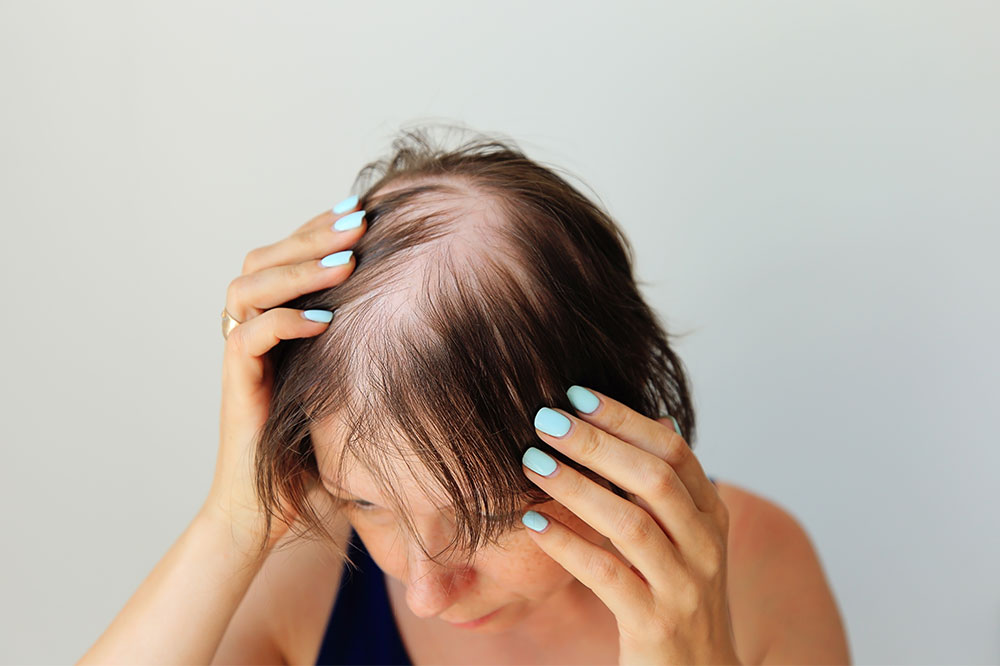 Important elements of alopecia areata