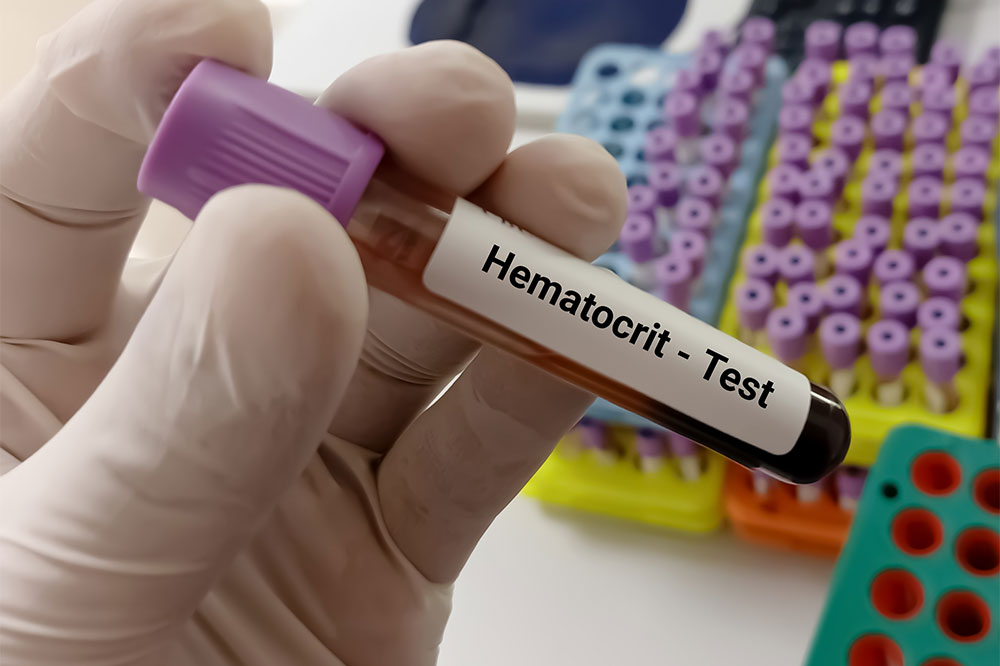 Key things to know about a hematocrit test