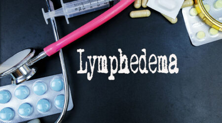 Known causes, signs, and management of lymphedema explained