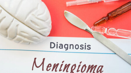 Meningioma &#8211; Causes, symptoms, and management